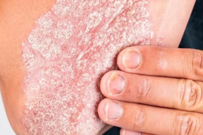 Patient Presents with Articular Pain and Silvery Dermatologic Lesions: Diagnostic Considerations