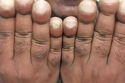 Patient with Prolonged Smoking History Exhibits Dyspnea, Exhaustion, and Nail Clubbing: Diagnostic Considerations